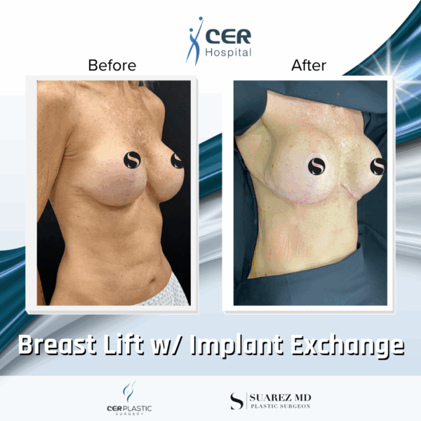 Breast Lift with Implants - 13013 - Image 4
