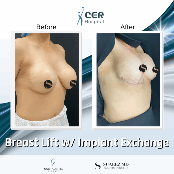 Breast Lift with Implant Exchange - 16013