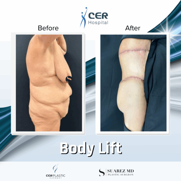 Body Lift - 31074
