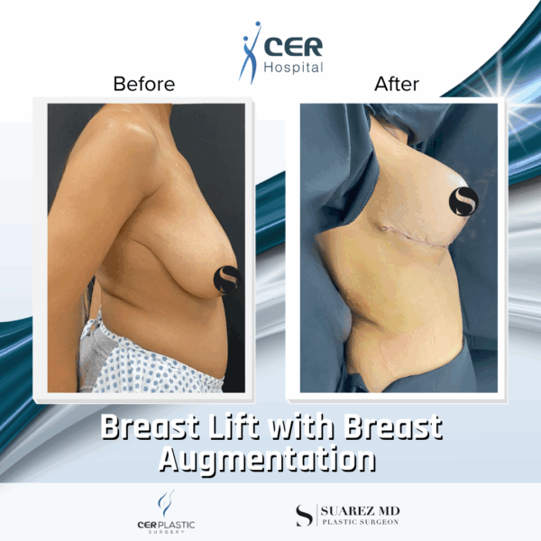 Breast Lift & Breast Augmentation - 16013 - Image 4