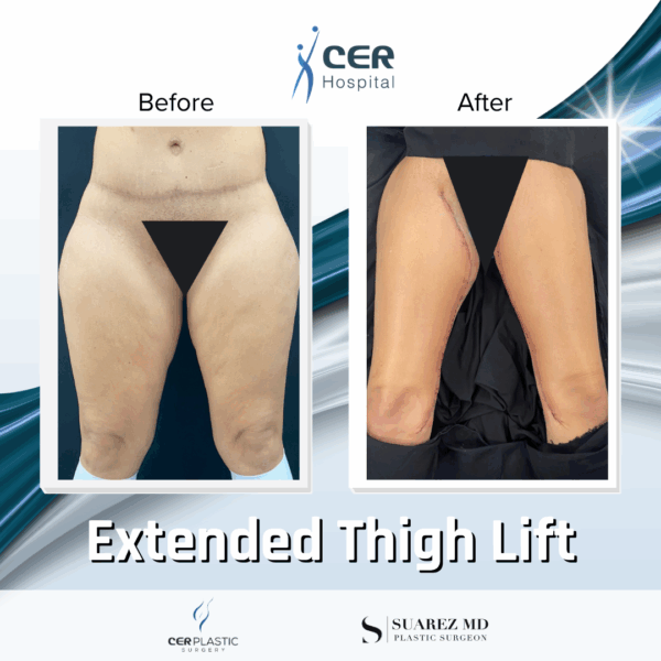 Extended Thigh Lift - 18013