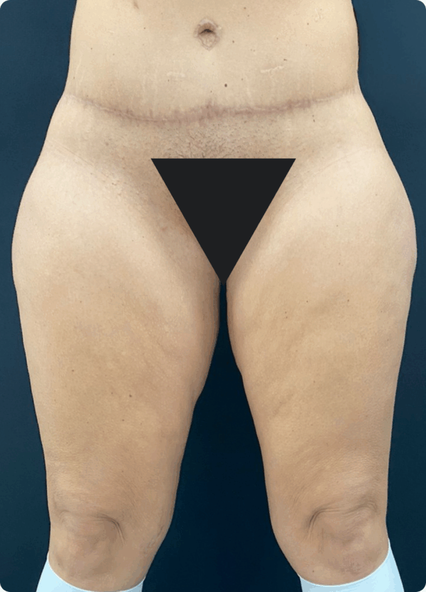 Extended Thigh Lift - 18013 - Image 3