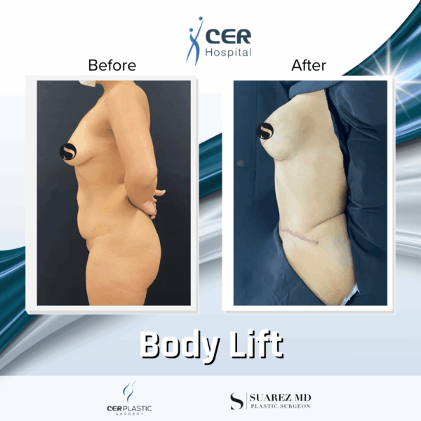 Body Lift - 18013 - Image 4