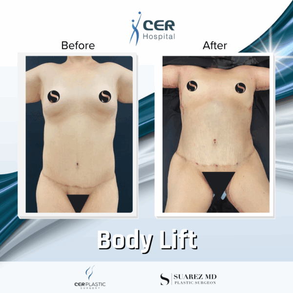 Body Lift - 20013 - Image 4
