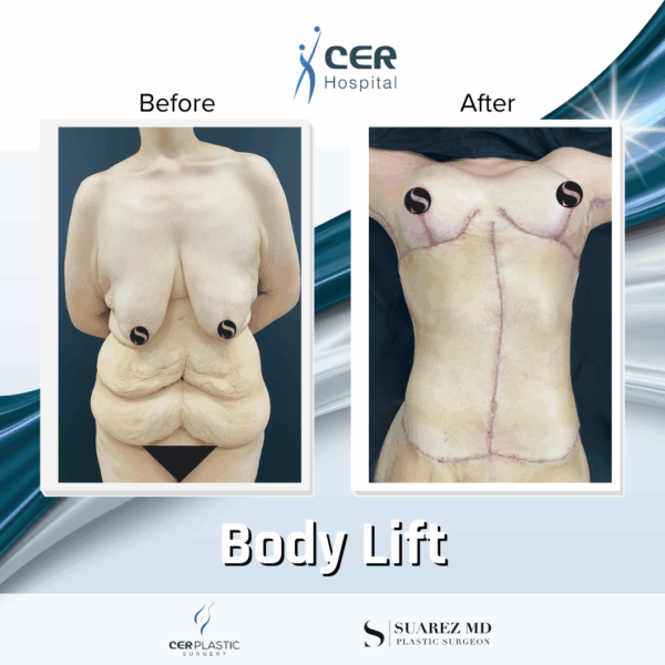 Body Lift - 20013 - Image 4