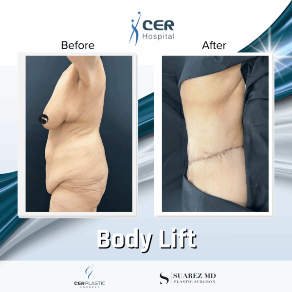 Body Lift - 23013