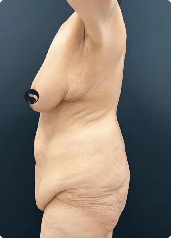 Body Lift - 23013 - Image 3