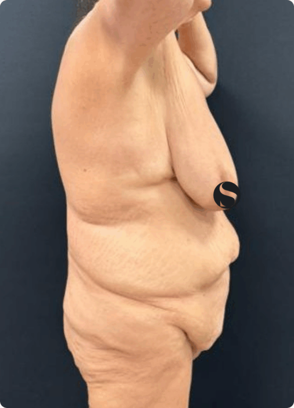 Body Lift - 31074 - Image 3