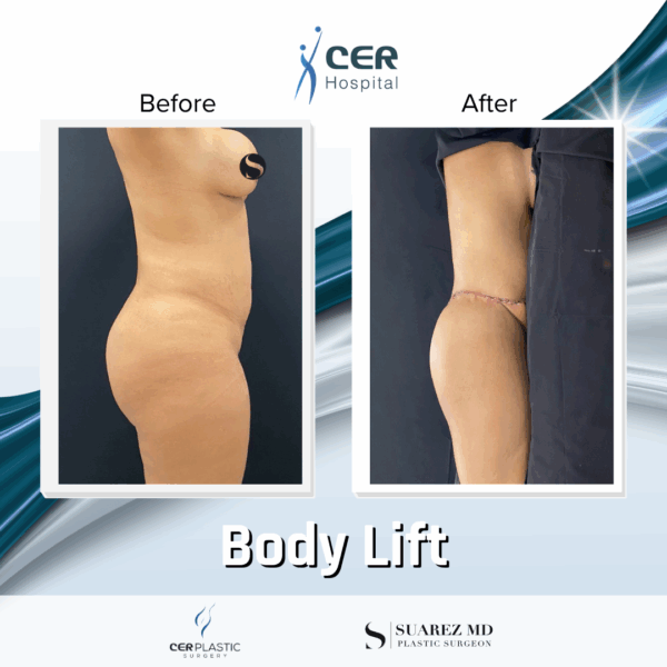 Body Lift - 26043 - Image 4