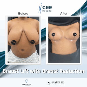 Breast Lift with Breast Reduction – 19043