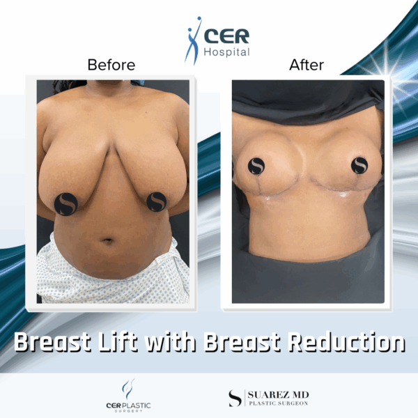 Breast Lift with Breast Reduction - 19043