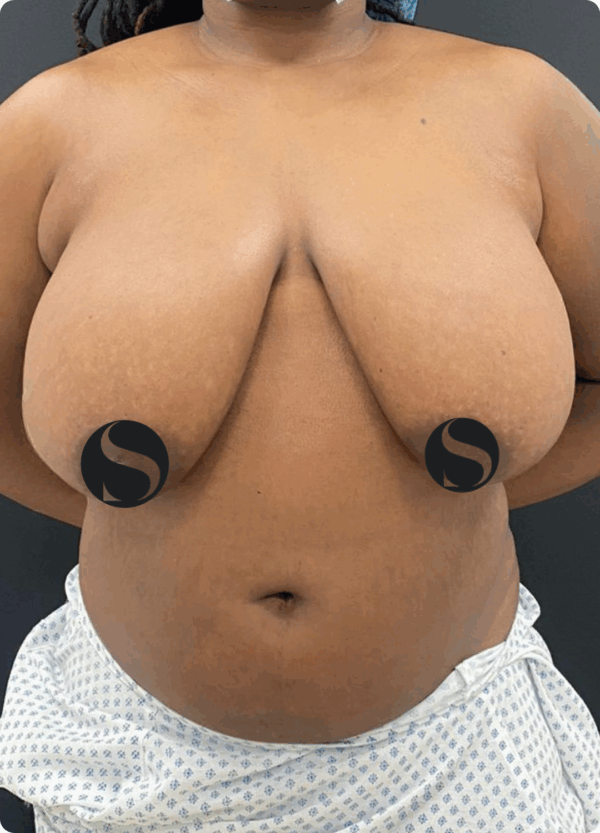 Breast Lift with Breast Reduction - 19043 - Image 3
