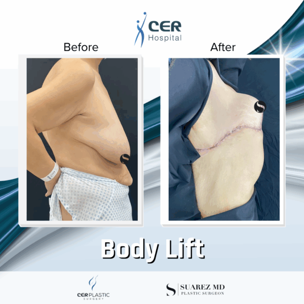 Body Lift - 10043 - Image 4