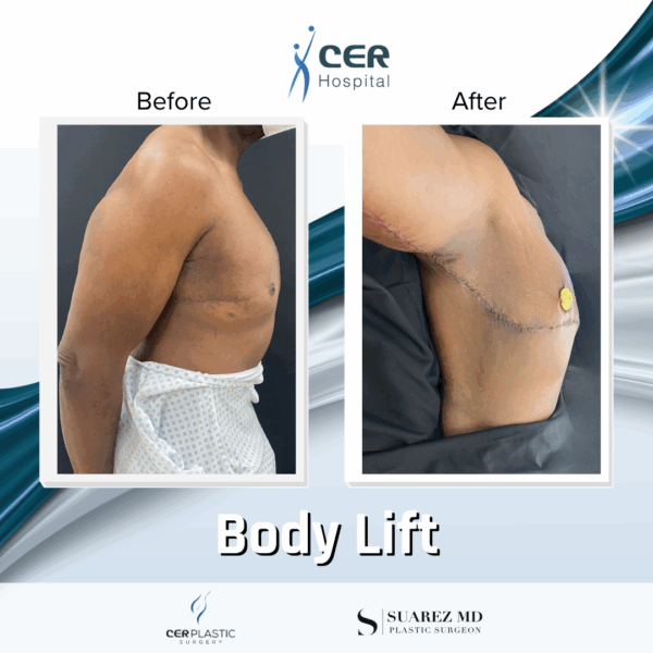 Body Lift - 19043 - Image 4
