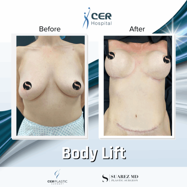 Body Lift - 5043 - Image 4