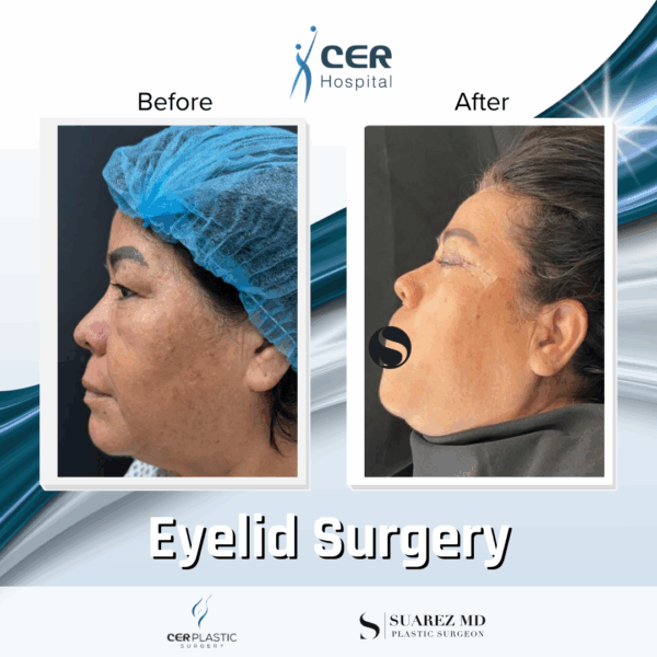 Eyelid Surgery - 5084 - Image 4