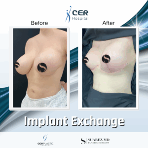 Implant Exchange – 3043