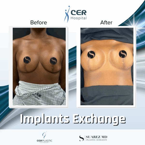 Implants Exchange - 5074