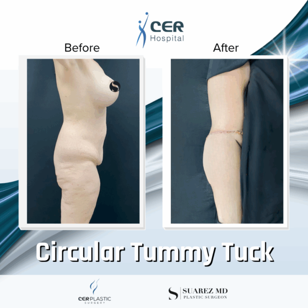 Circular Tummy Tuck - 3043 - Image 5