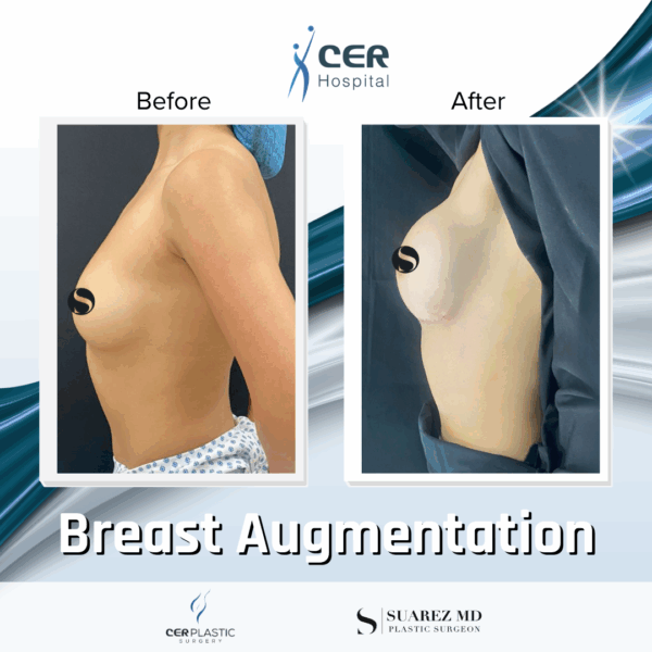 Breast Augmentation - 31053 - Image 4