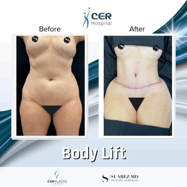 Body Lift - 16084 - Image 4