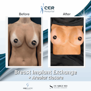 Breast Implant Exchange – 4094