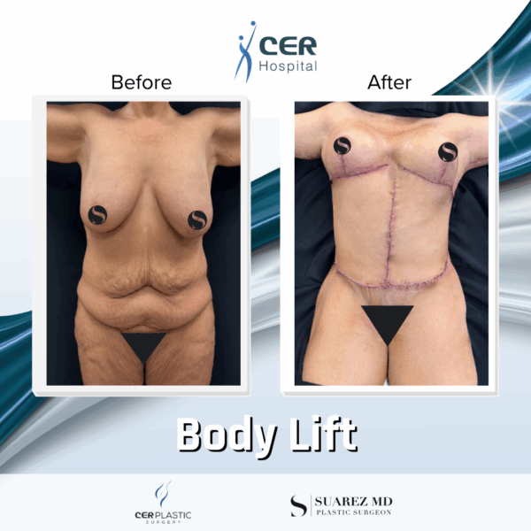 Body Lift - 0608 - Image 12