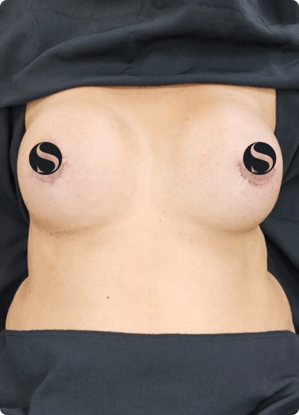Implant Exchange - 24054 - Image 2