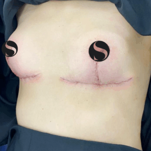 Breast Lift with Implant Removal – 14104