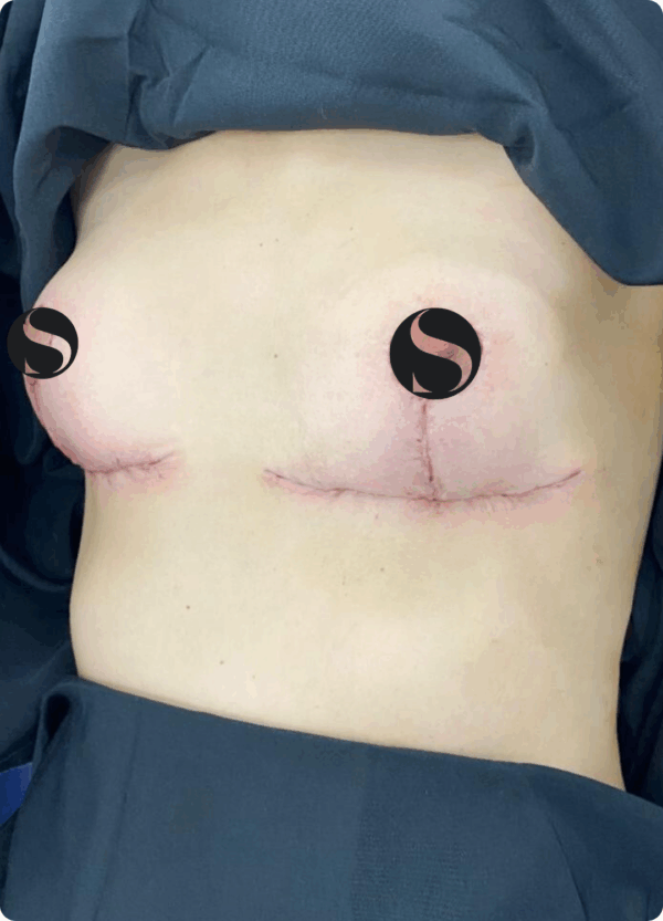 Breast Lift with Implant Removal - 14104 - Image 2
