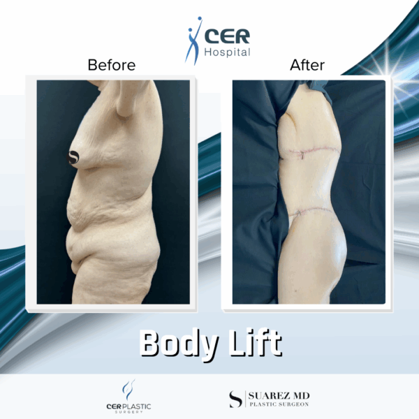 Body Lift - 24104 - Image 12