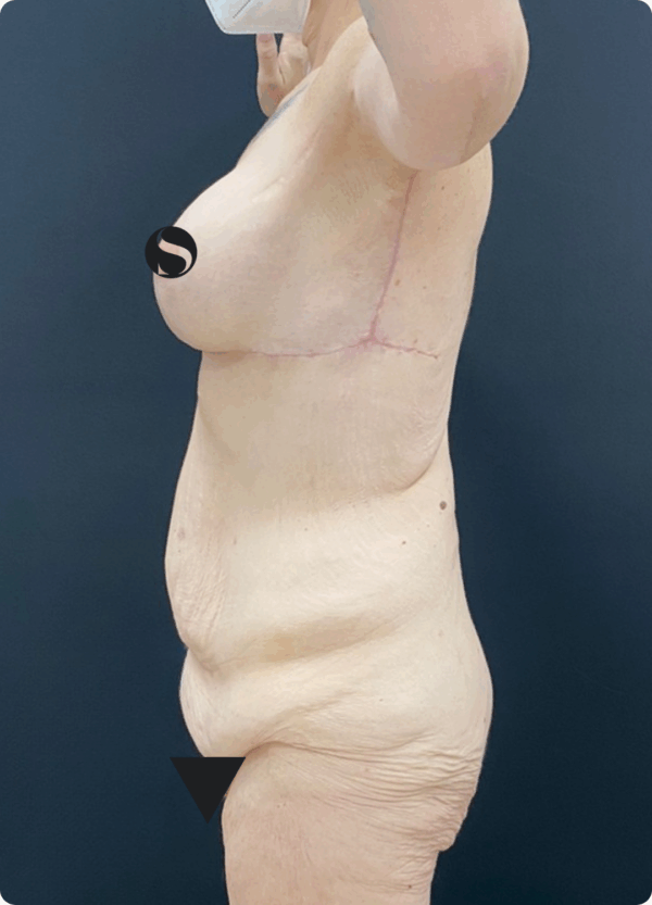 Body Lift - 8013 - Image 3