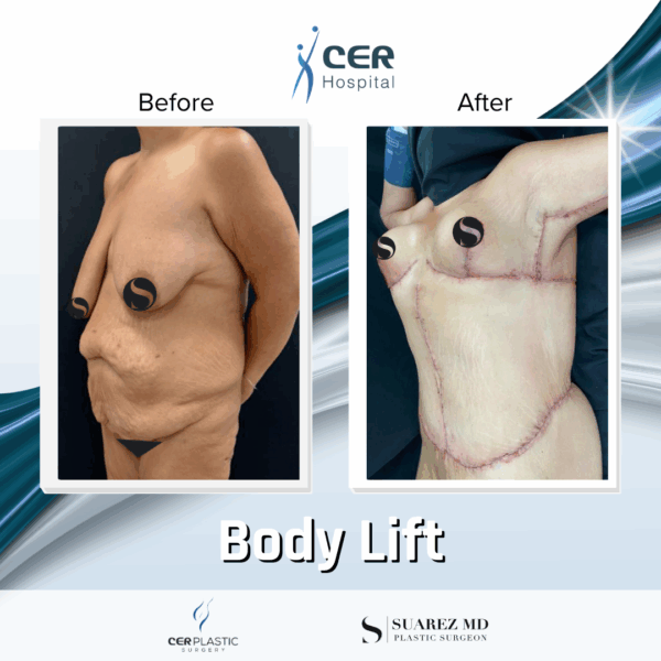 Body Lift - 31074 - Image 12