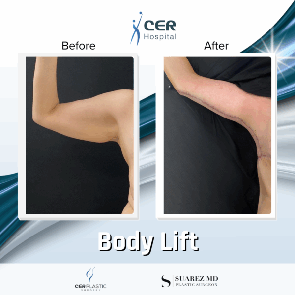 Body Lift - 20013 - Image 12