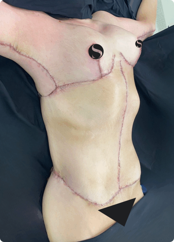 Body Lift - 20013 - Image 2