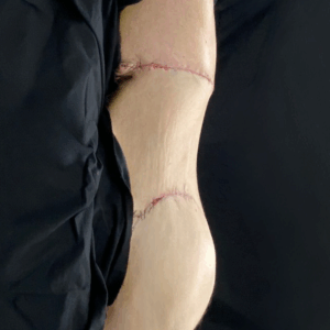 Body Lift – 8013