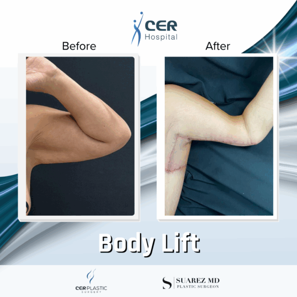 Body Lift - 31074 - Image 13