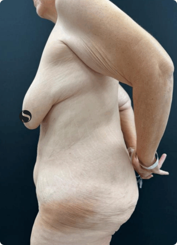 Body Lift - 10124 - Image 3