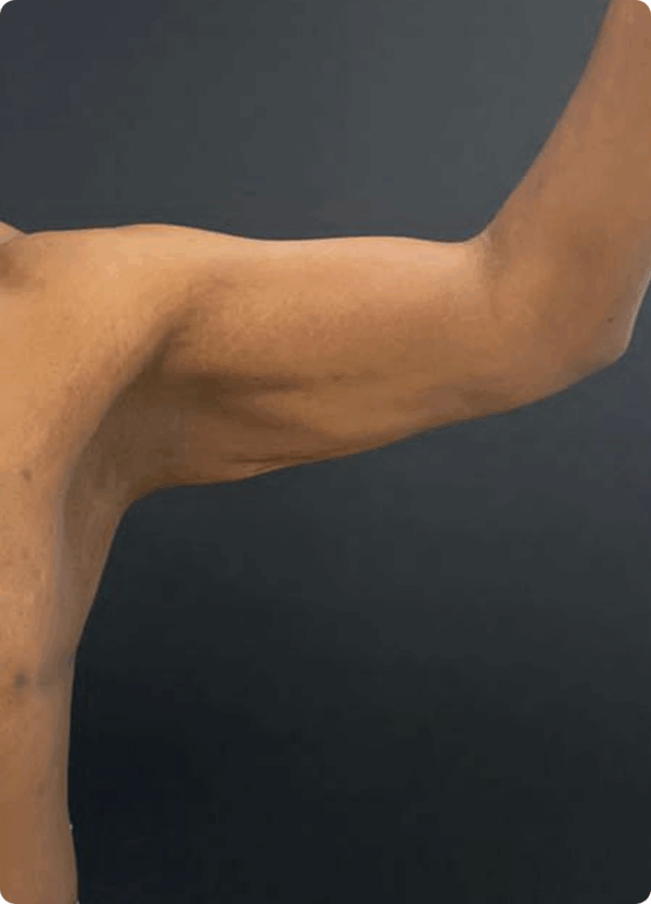 Body Lift - 19043 - Image 3