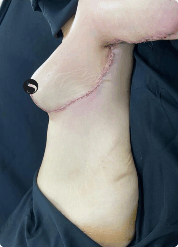Body Lift - 10124 - Image 2