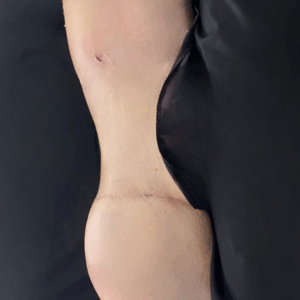 Body Lift – 20013