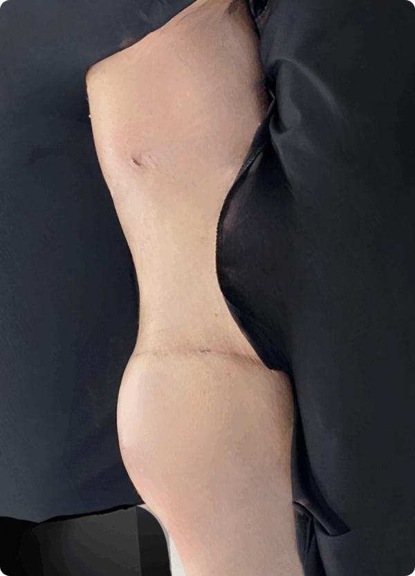 Body Lift - 20013 - Image 2