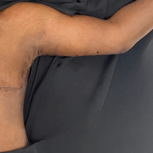 Body Lift – 19043