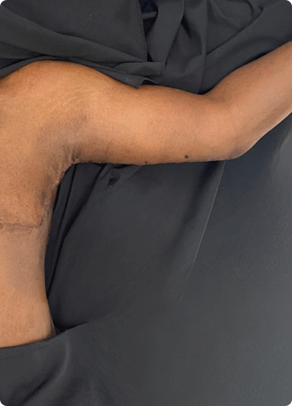 Body Lift - 19043 - Image 2