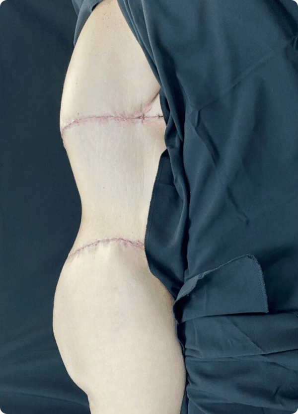 Body Lift - 24104 - Image 2