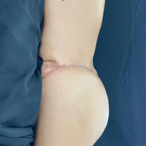 Body Lift – 20084