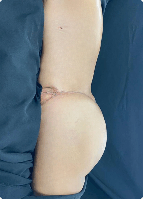 Body Lift - 20084 - Image 2