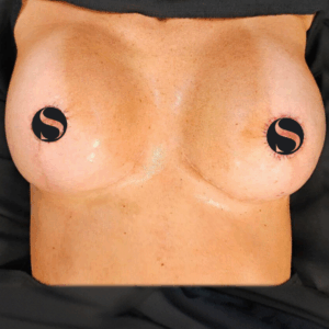 Breast Implant Exchange – 4094