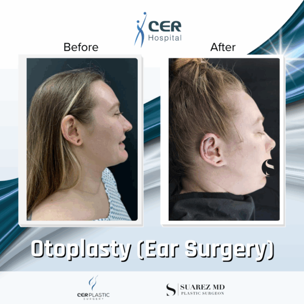 Otoplasty - 4094 - Image 5