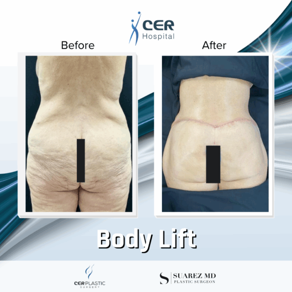 Body Lift - 18094 - Image 5